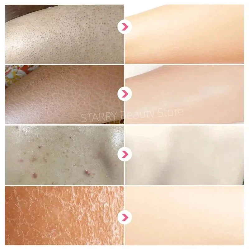 Curing Keratosis Pilaris Chicken Follicle Skin Repair Cream Body Dark Spot Remove Whitening Smooth Moisturize Skincare Body loti